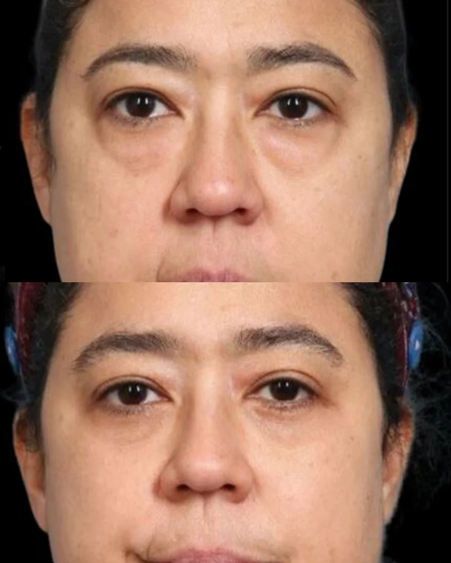 Before and after oculofacial plastic surgery results in Atlanta, GA, performed by Dr. Sahitya Reddy.