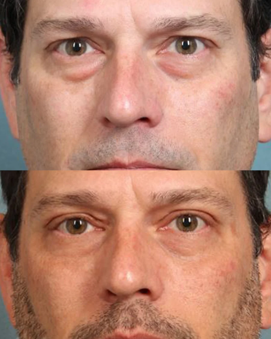 Before and after oculofacial plastic surgery results in Atlanta, GA, performed by Dr. Sahitya Reddy.