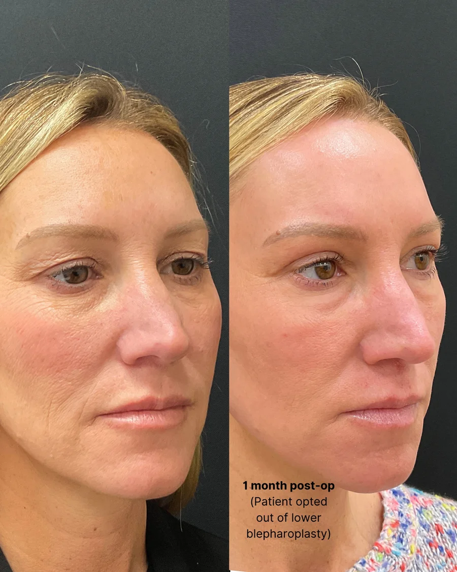 Before and after oculofacial plastic surgery results in Atlanta, GA, performed by Dr. Sahitya Reddy.