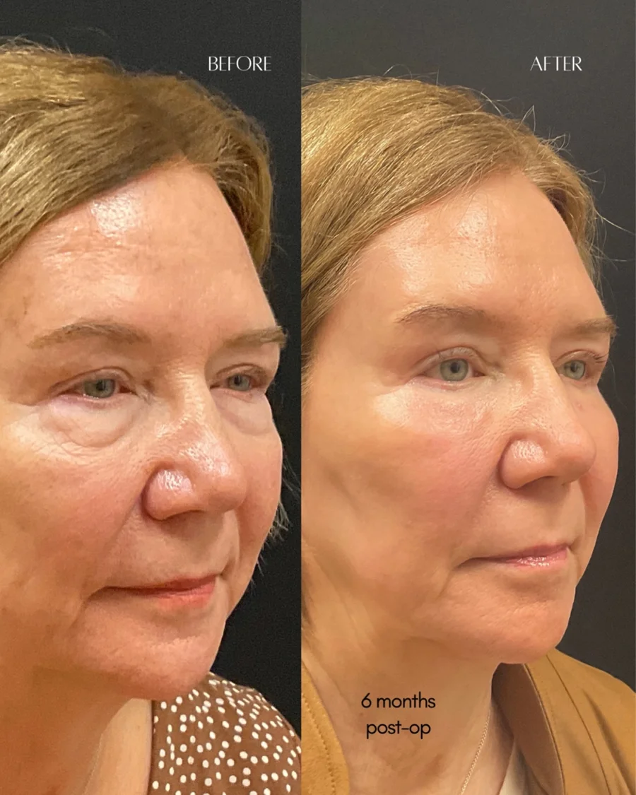 Before and after oculofacial plastic surgery results in Atlanta, GA, performed by Dr. Sahitya Reddy.