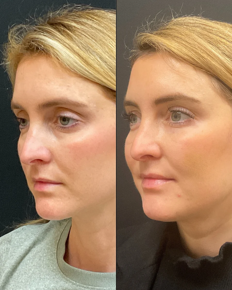 Before and after oculofacial plastic surgery results in Atlanta, GA, performed by Dr. Sahitya Reddy.