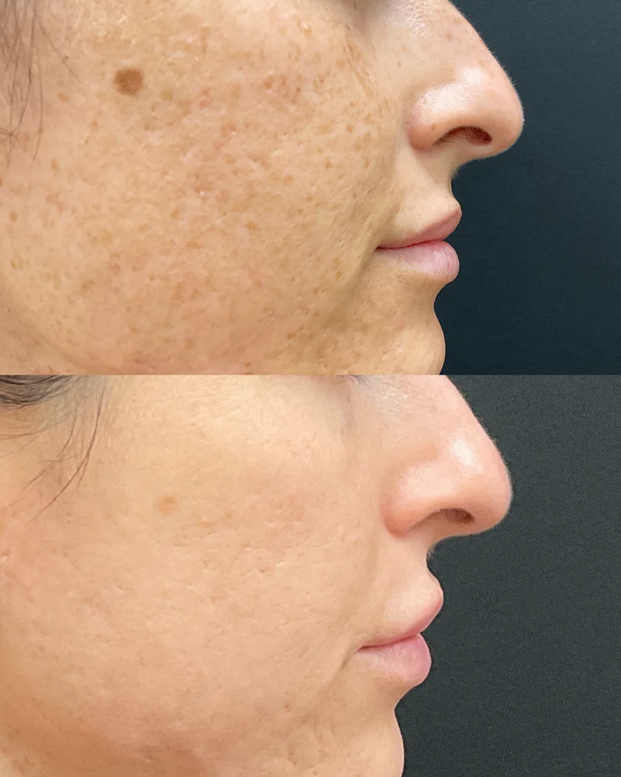 Before and after oculofacial plastic surgery results in Atlanta, GA, performed by Dr. Sahitya Reddy.