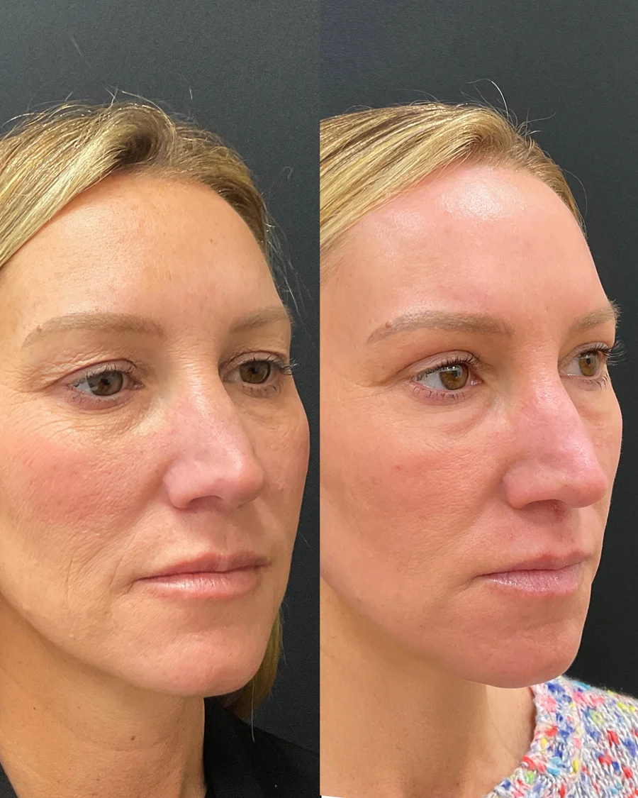 Before and after oculofacial plastic surgery results in Atlanta, GA, performed by Dr. Sahitya Reddy.