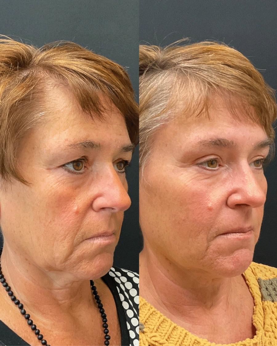 Before and after oculofacial plastic surgery results in Atlanta, GA, performed by Dr. Sahitya Reddy.