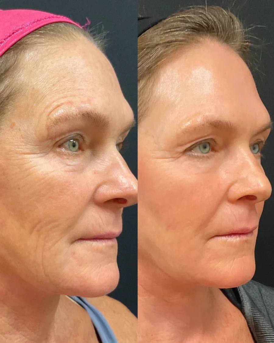 Before and after oculofacial plastic surgery results in Atlanta, GA, performed by Dr. Sahitya Reddy.