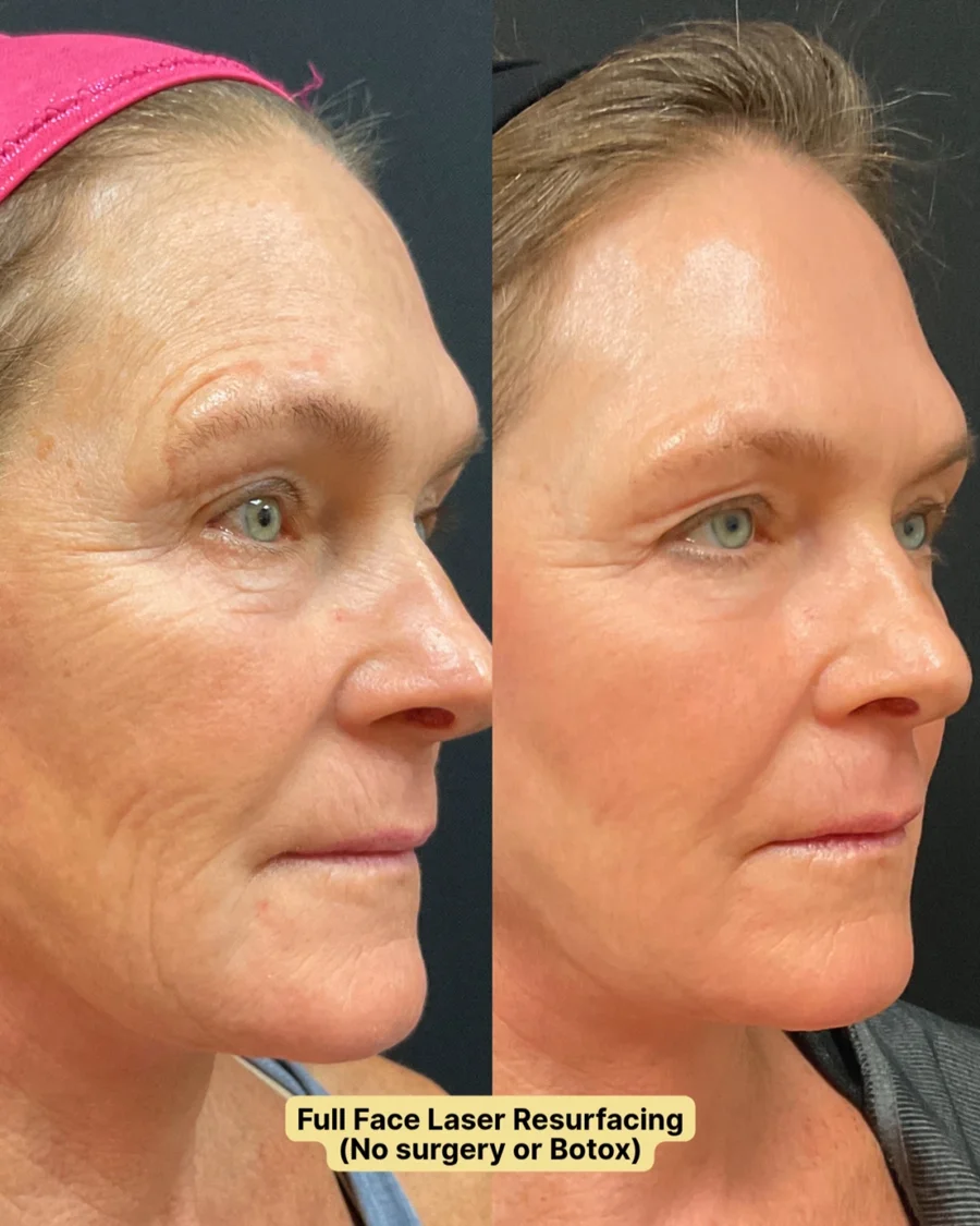 Before and after oculofacial plastic surgery results in Atlanta, GA, performed by Dr. Sahitya Reddy.