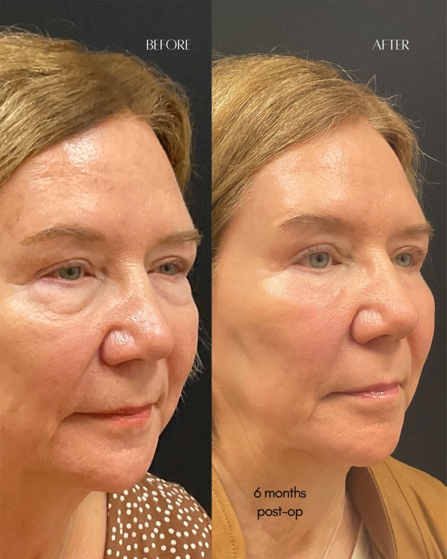Before and after oculofacial plastic surgery results in Atlanta, GA, performed by Dr. Sahitya Reddy.