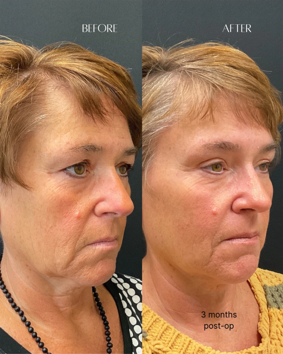 Before and after oculofacial plastic surgery results in Atlanta, GA, performed by Dr. Sahitya Reddy.