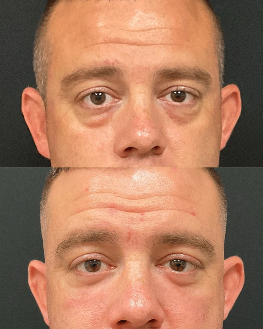 Before and after oculofacial plastic surgery results in Atlanta, GA, performed by Dr. Sahitya Reddy.