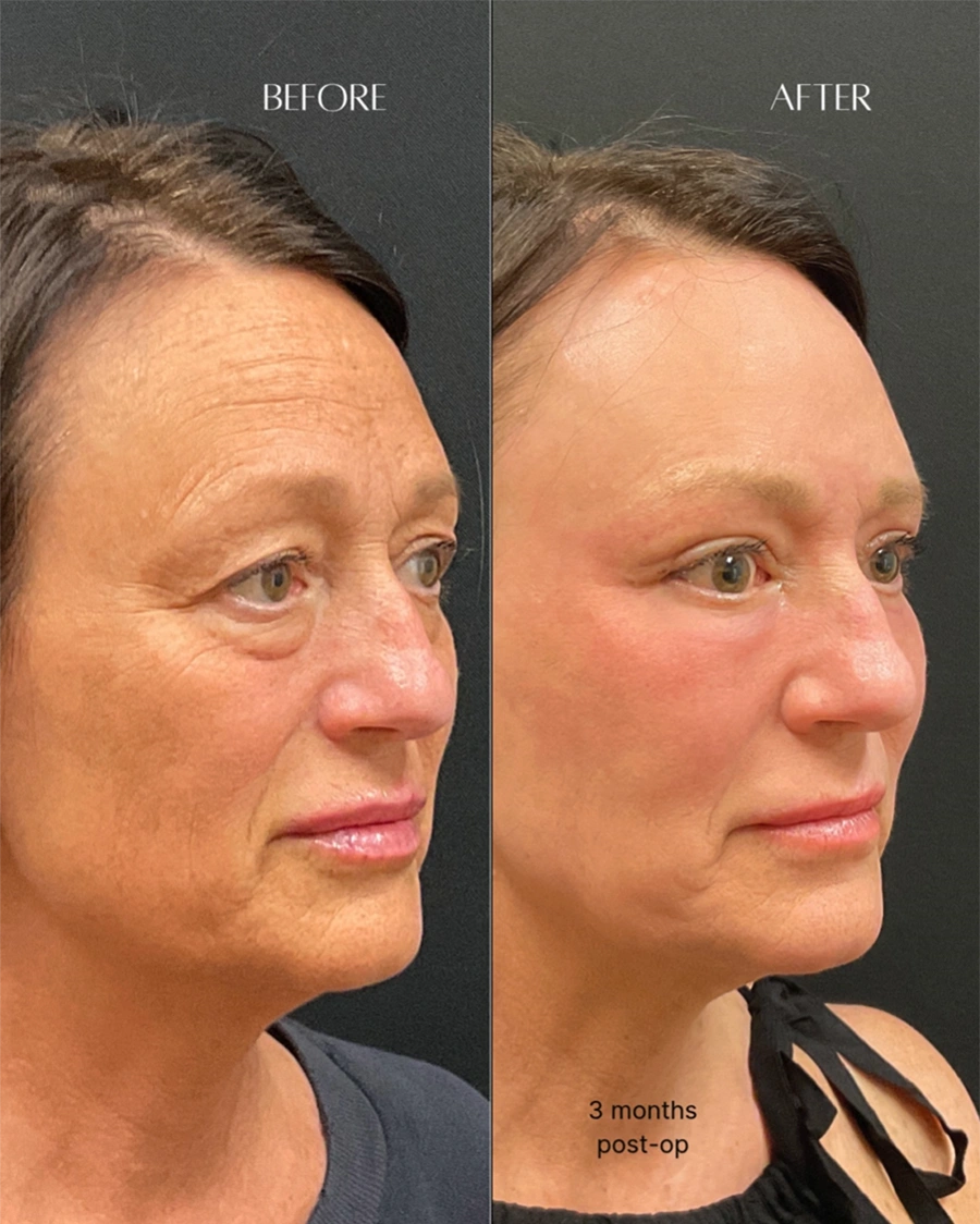 Before and after oculofacial plastic surgery results in Atlanta, GA, performed by Dr. Sahitya Reddy.