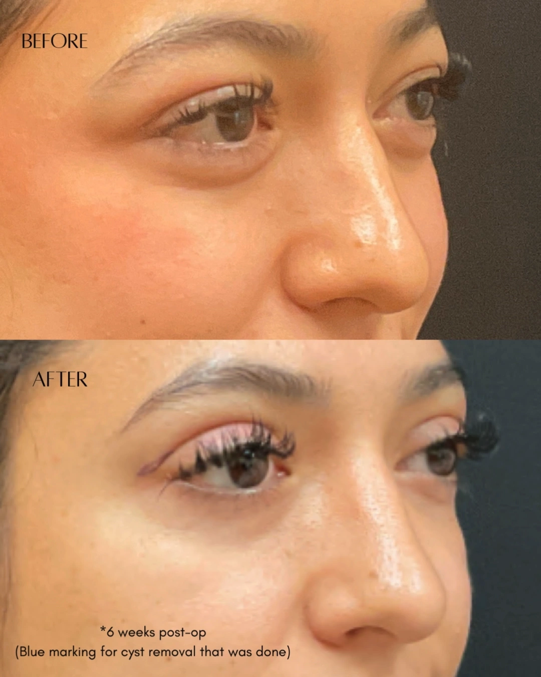 Before and after oculofacial plastic surgery results in Atlanta, GA, performed by Dr. Sahitya Reddy.