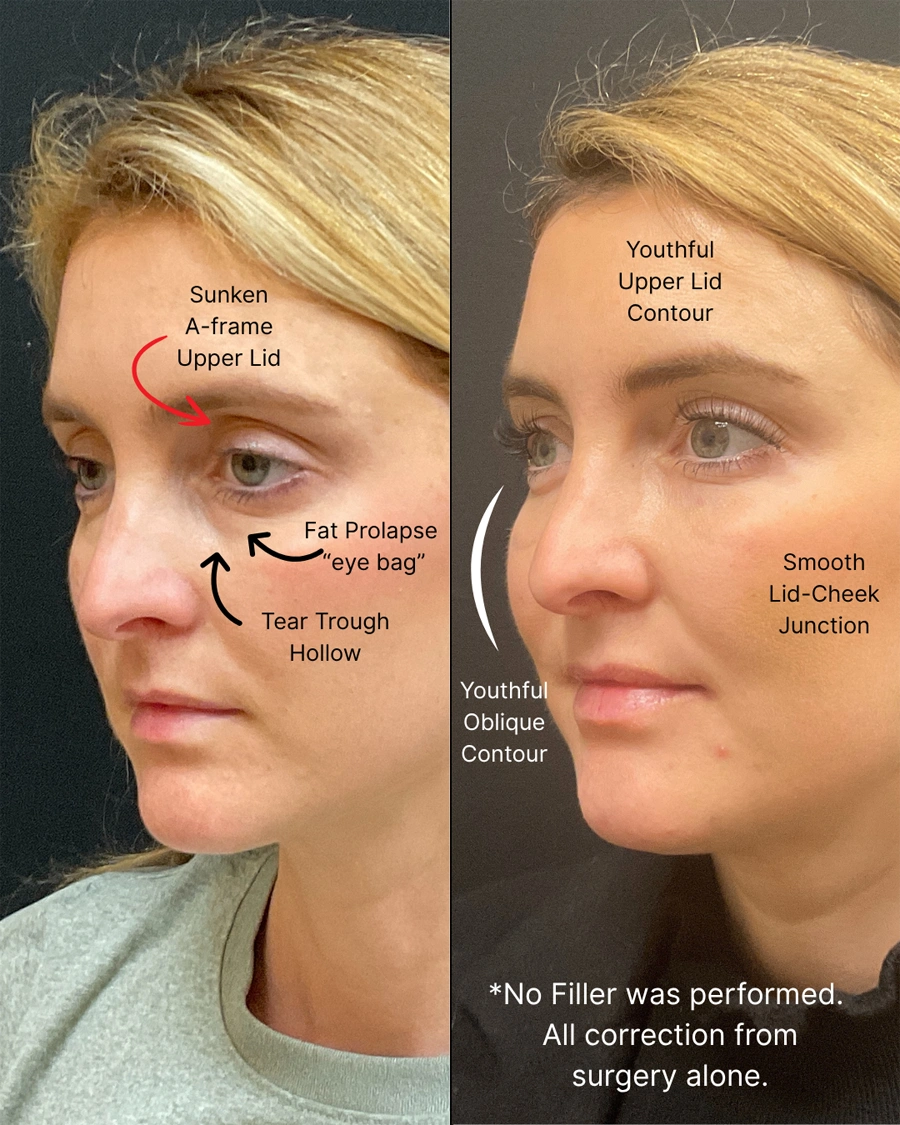 Before and after oculofacial plastic surgery results in Atlanta, GA, performed by Dr. Sahitya Reddy.
