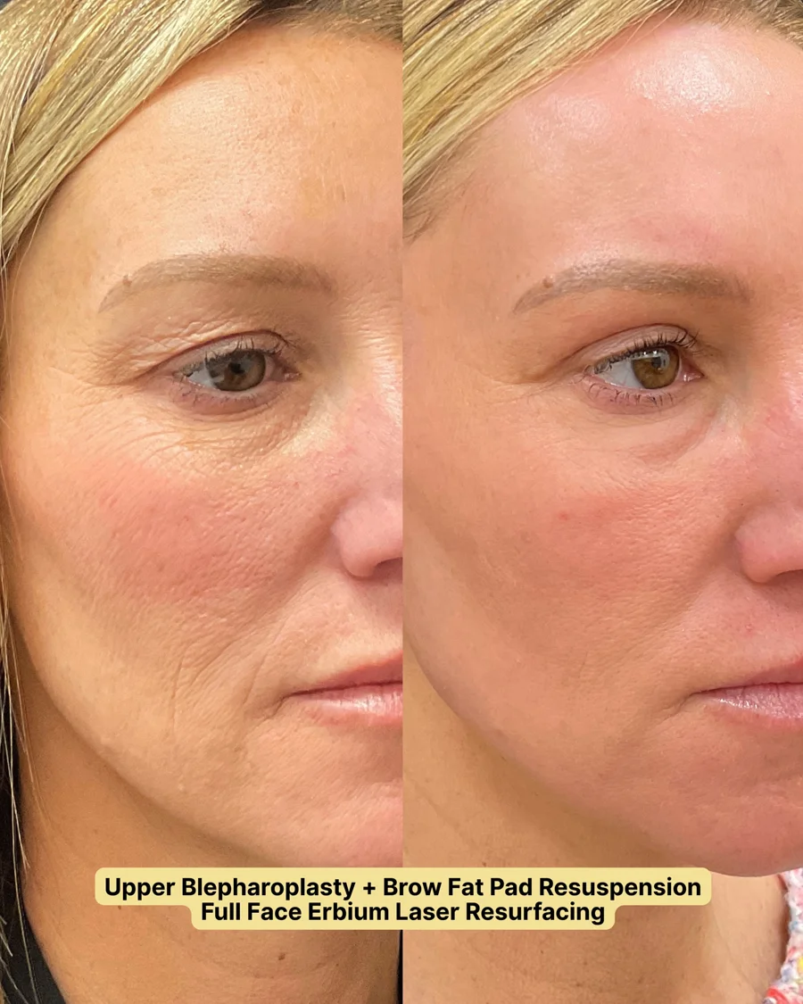Before and after oculofacial plastic surgery results in Atlanta, GA, performed by Dr. Sahitya Reddy.
