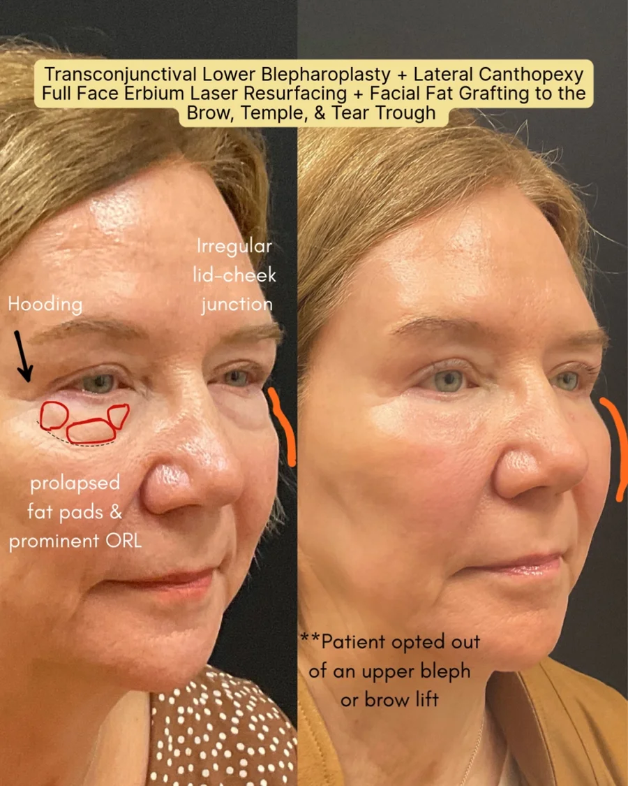 Before and after oculofacial plastic surgery results in Atlanta, GA, performed by Dr. Sahitya Reddy.