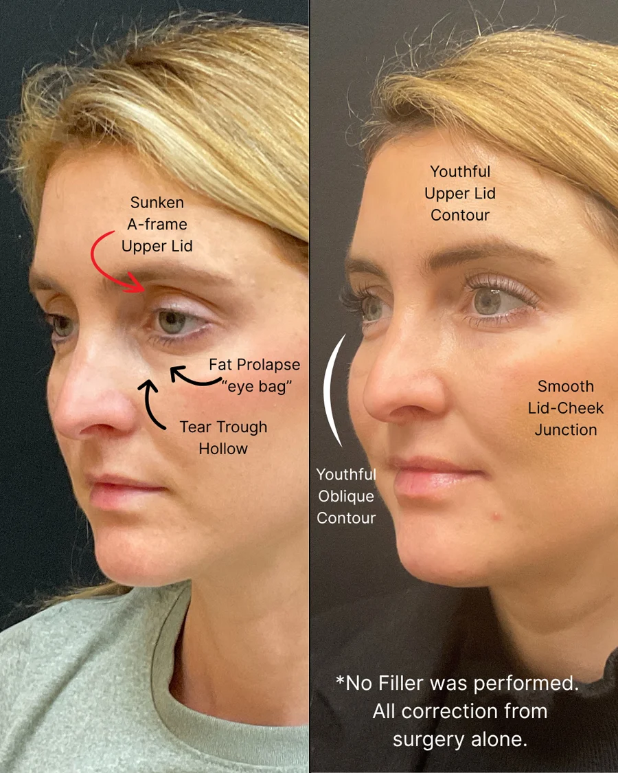 Before and after oculofacial plastic surgery results in Atlanta, GA, performed by Dr. Sahitya Reddy.