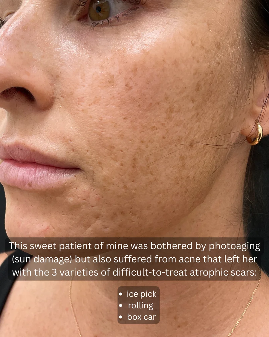 Before and after oculofacial plastic surgery results in Atlanta, GA, performed by Dr. Sahitya Reddy.