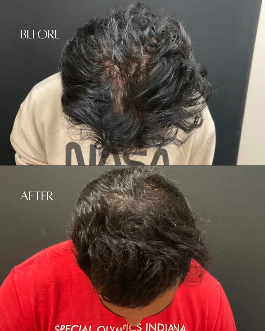 Before and after oculofacial plastic surgery results in Atlanta, GA, performed by Dr. Sahitya Reddy.