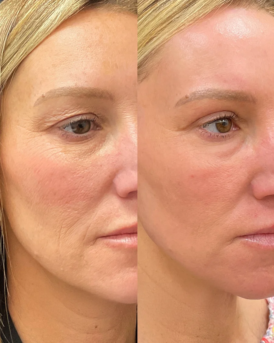 Before and after oculofacial plastic surgery results in Atlanta, GA, performed by Dr. Sahitya Reddy.