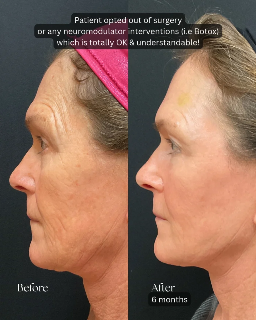 Before and after oculofacial plastic surgery results in Atlanta, GA, performed by Dr. Sahitya Reddy.