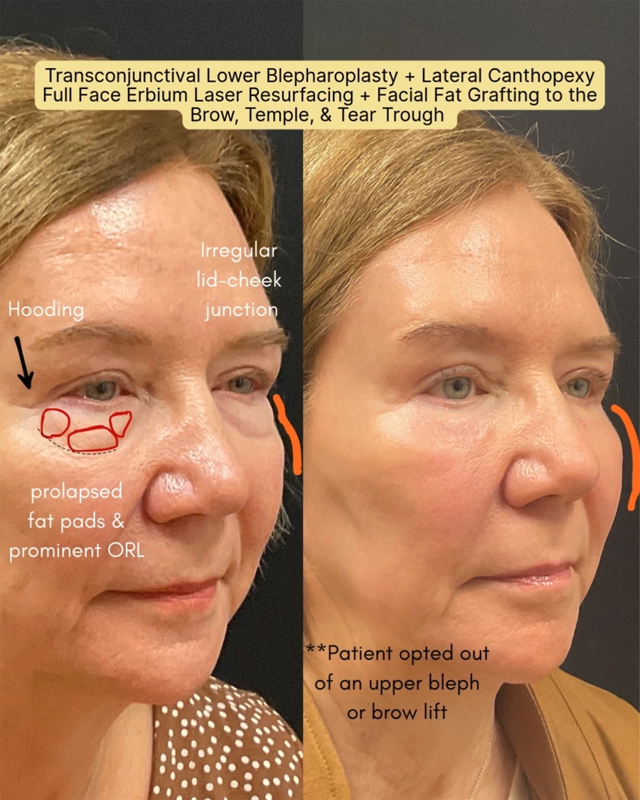 Before and after oculofacial plastic surgery results in Atlanta, GA, performed by Dr. Sahitya Reddy.