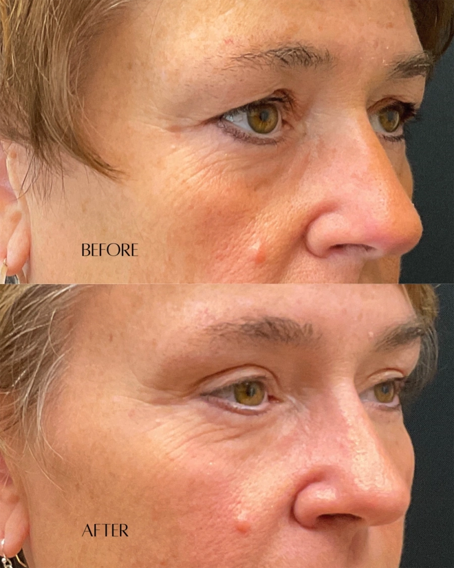 Before and after oculofacial plastic surgery results in Atlanta, GA, performed by Dr. Sahitya Reddy.