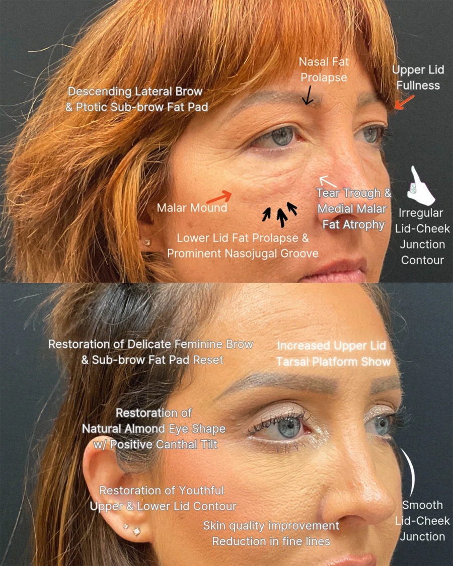 Before and after oculofacial plastic surgery results in Atlanta, GA, performed by Dr. Sahitya Reddy.