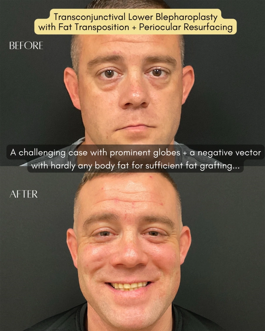 Before and after oculofacial plastic surgery results in Atlanta, GA, performed by Dr. Sahitya Reddy.