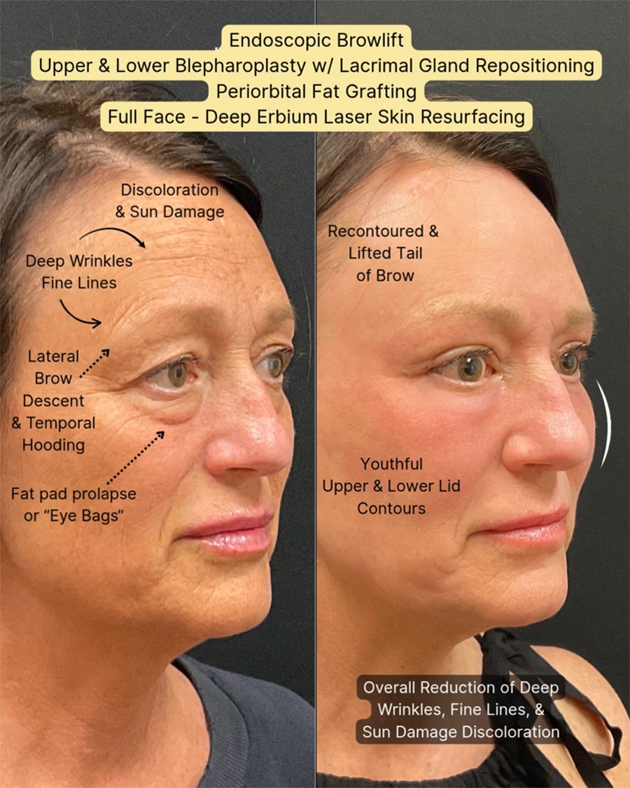 Before and after oculofacial plastic surgery results in Atlanta, GA, performed by Dr. Sahitya Reddy.