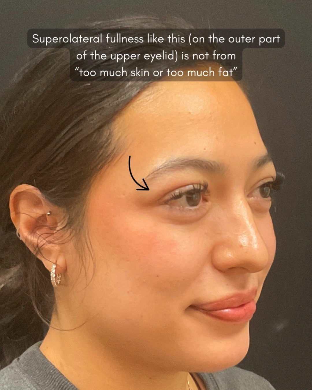 Before and after oculofacial plastic surgery results in Atlanta, GA, performed by Dr. Sahitya Reddy.