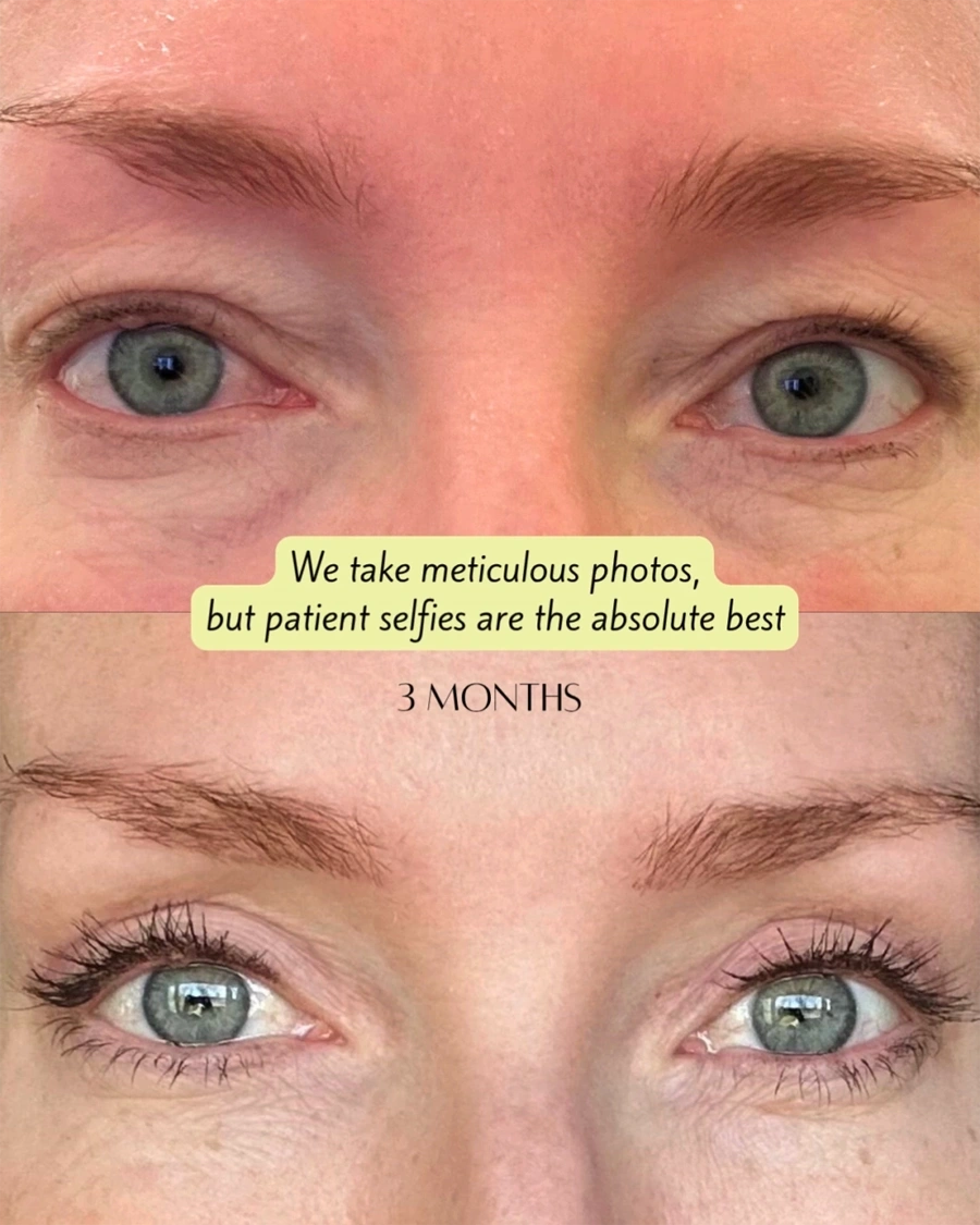 Before and after oculofacial plastic surgery results in Atlanta, GA, performed by Dr. Sahitya Reddy.