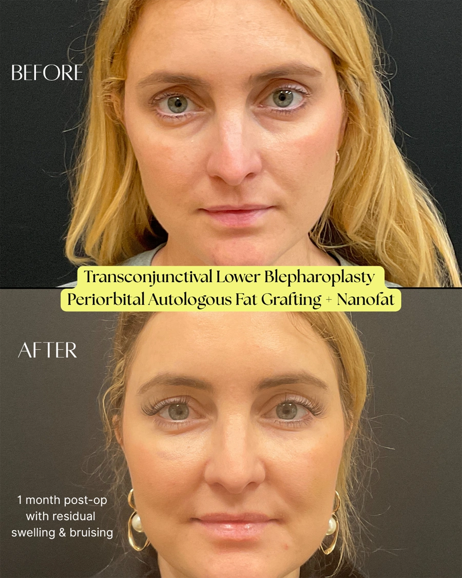 Before and after oculofacial plastic surgery results in Atlanta, GA, performed by Dr. Sahitya Reddy.
