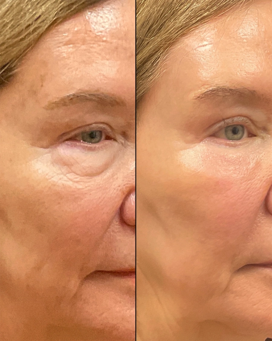 Before and after oculofacial plastic surgery results in Atlanta, GA, performed by Dr. Sahitya Reddy.