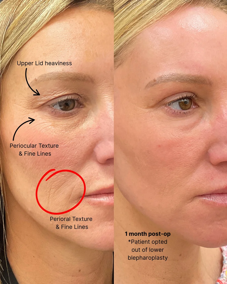Before and after oculofacial plastic surgery results in Atlanta, GA, performed by Dr. Sahitya Reddy.