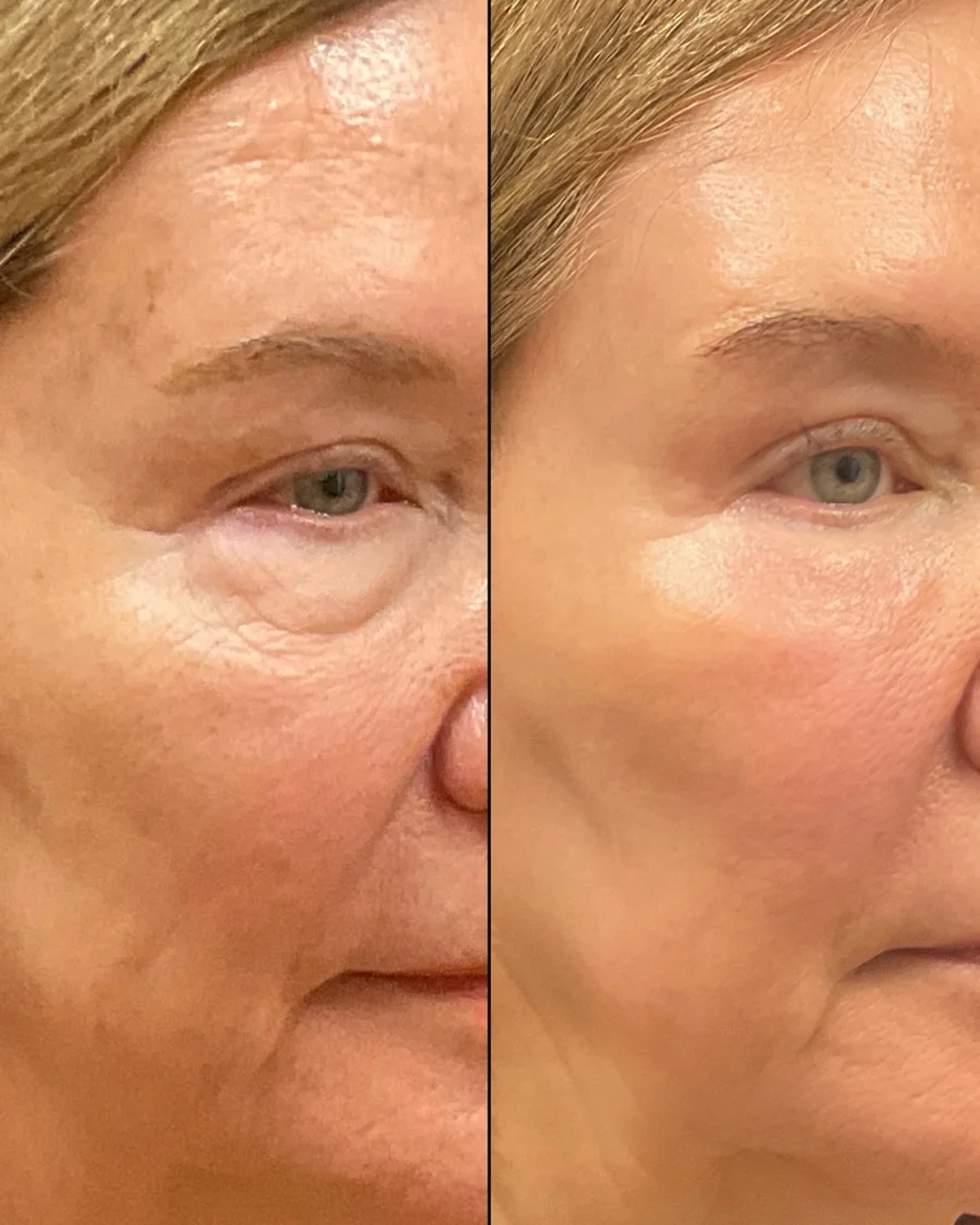 Before and after oculofacial plastic surgery results in Atlanta, GA, performed by Dr. Sahitya Reddy.