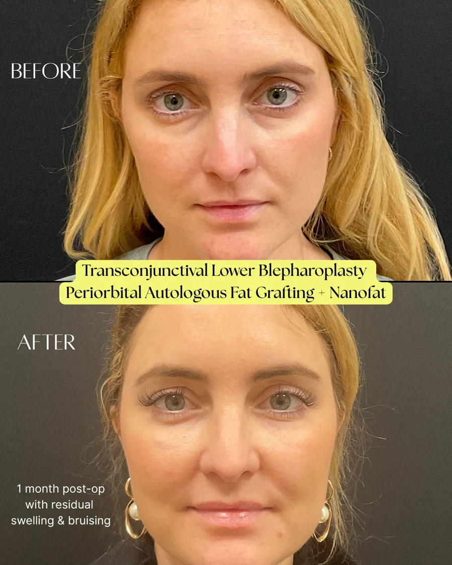 Before and after oculofacial plastic surgery results in Atlanta, GA, performed by Dr. Sahitya Reddy.