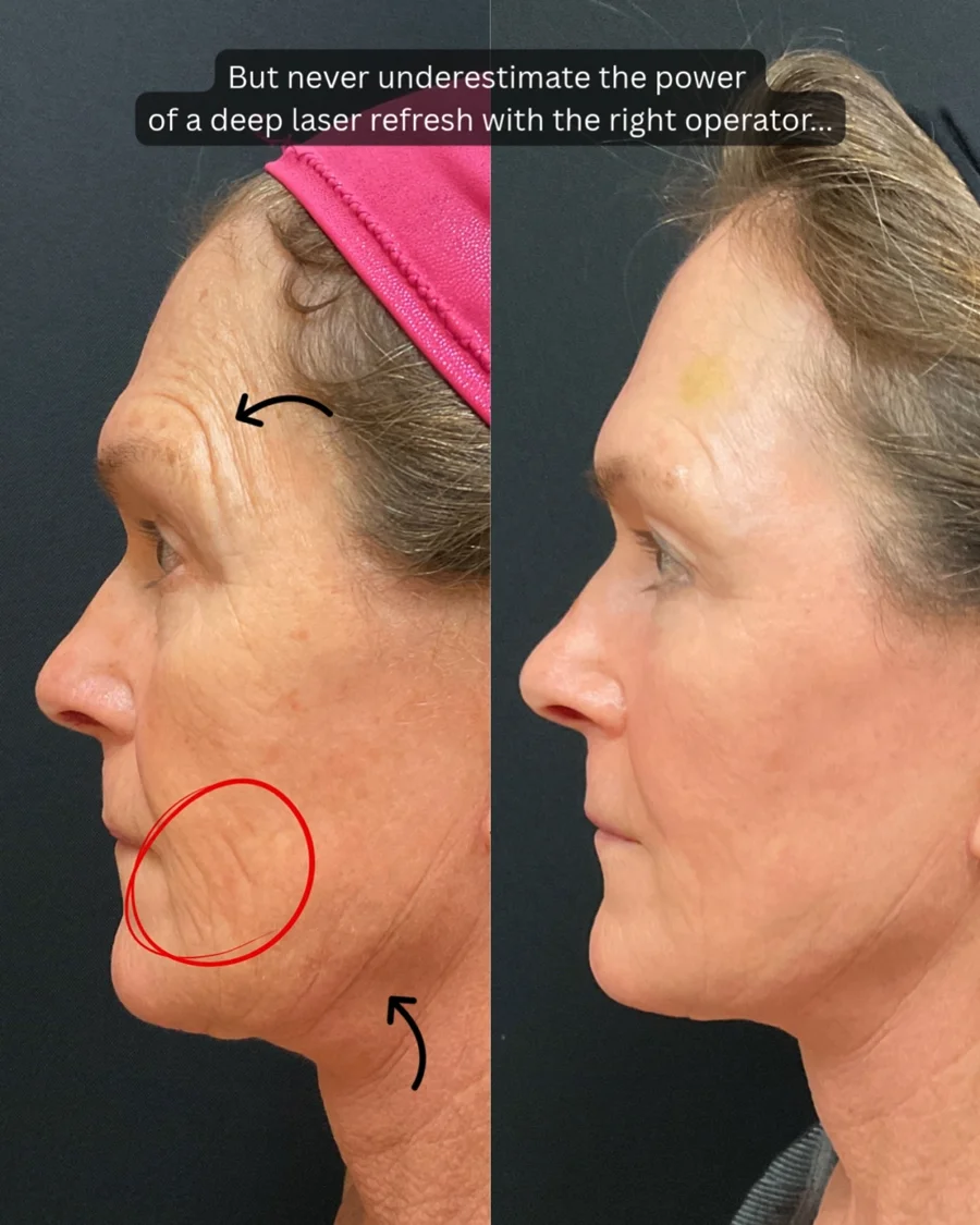 Before and after oculofacial plastic surgery results in Atlanta, GA, performed by Dr. Sahitya Reddy.