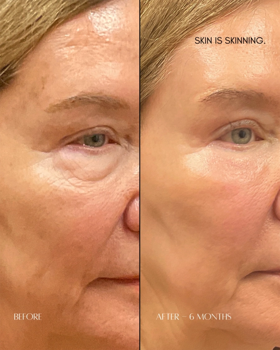 Before and after oculofacial plastic surgery results in Atlanta, GA, performed by Dr. Sahitya Reddy.