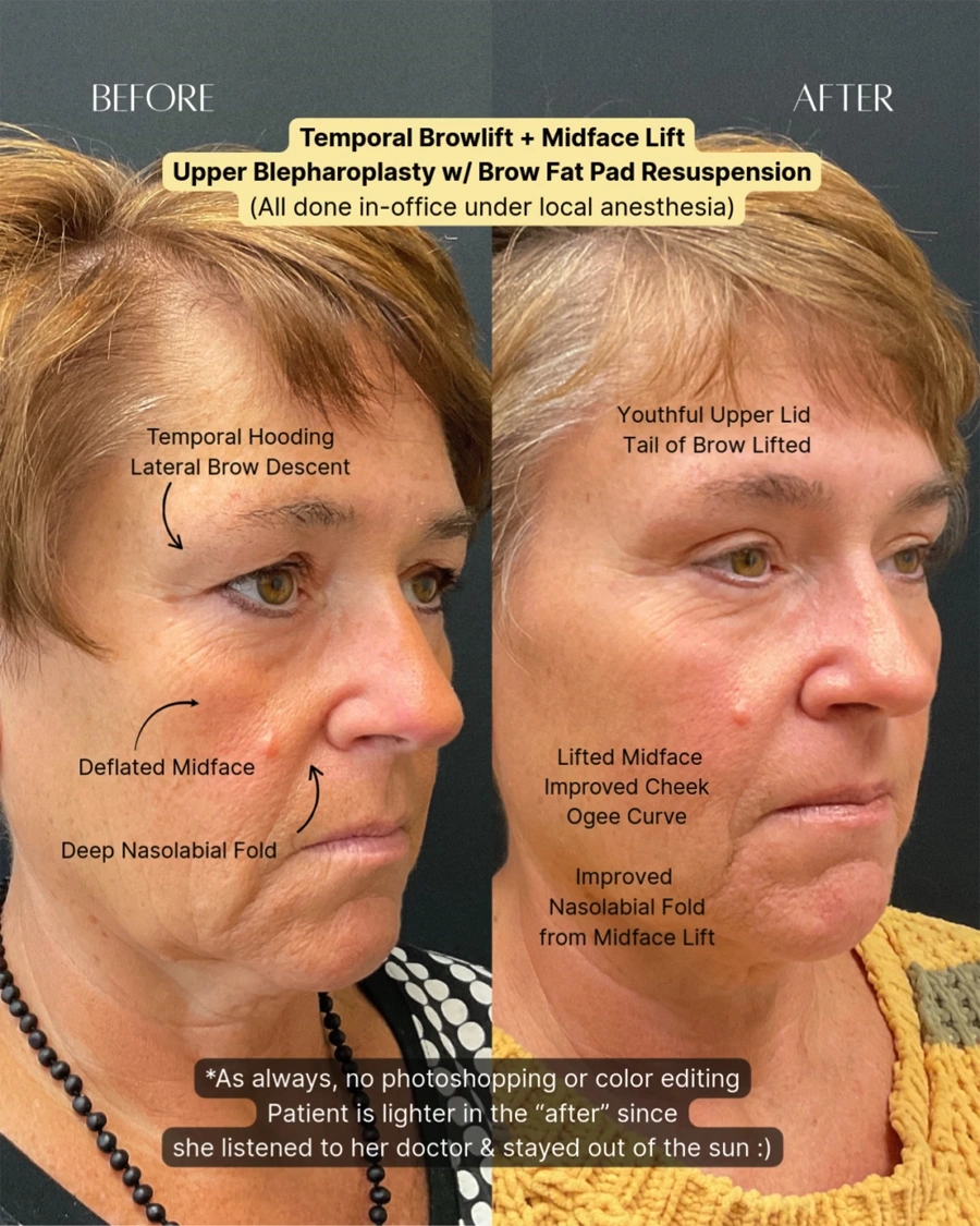 Before and after oculofacial plastic surgery results in Atlanta, GA, performed by Dr. Sahitya Reddy.