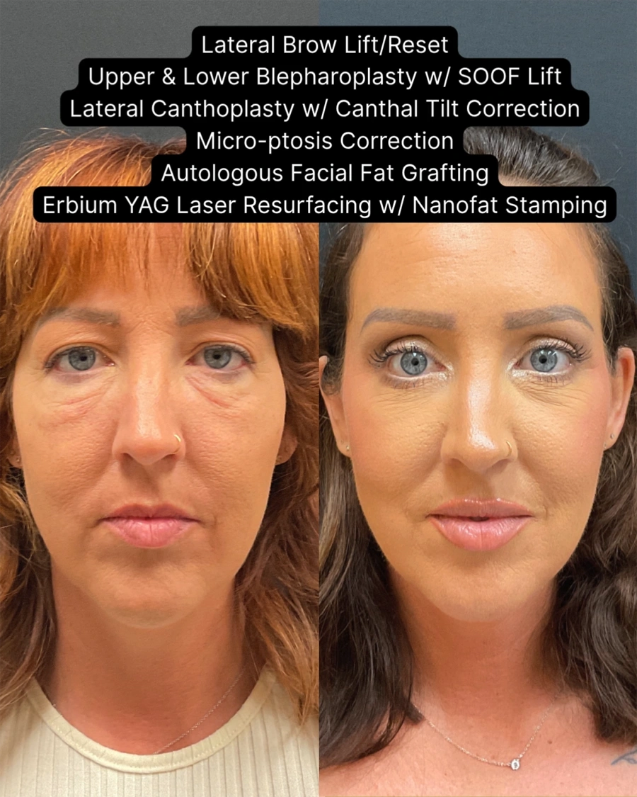 Before and after oculofacial plastic surgery results in Atlanta, GA, performed by Dr. Sahitya Reddy.