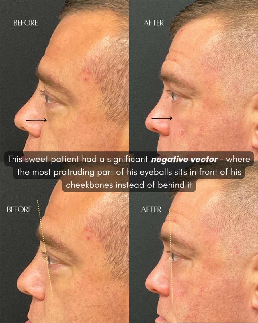 Before and after oculofacial plastic surgery results in Atlanta, GA, performed by Dr. Sahitya Reddy.