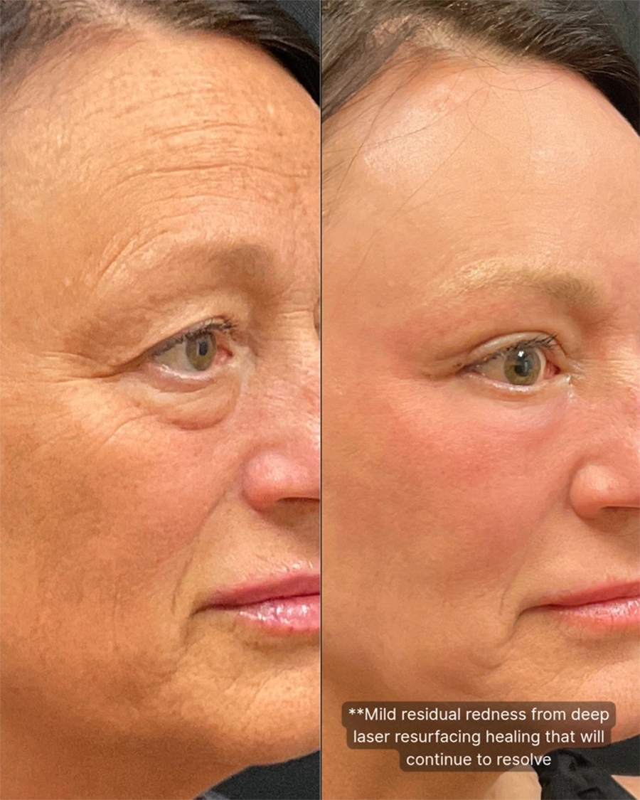 Before and after oculofacial plastic surgery results in Atlanta, GA, performed by Dr. Sahitya Reddy.