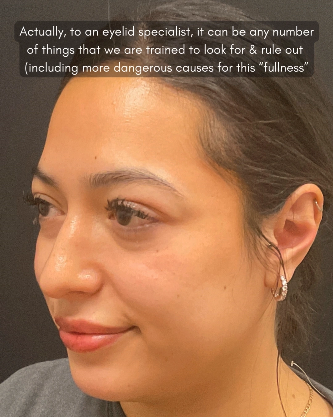 Before and after oculofacial plastic surgery results in Atlanta, GA, performed by Dr. Sahitya Reddy.