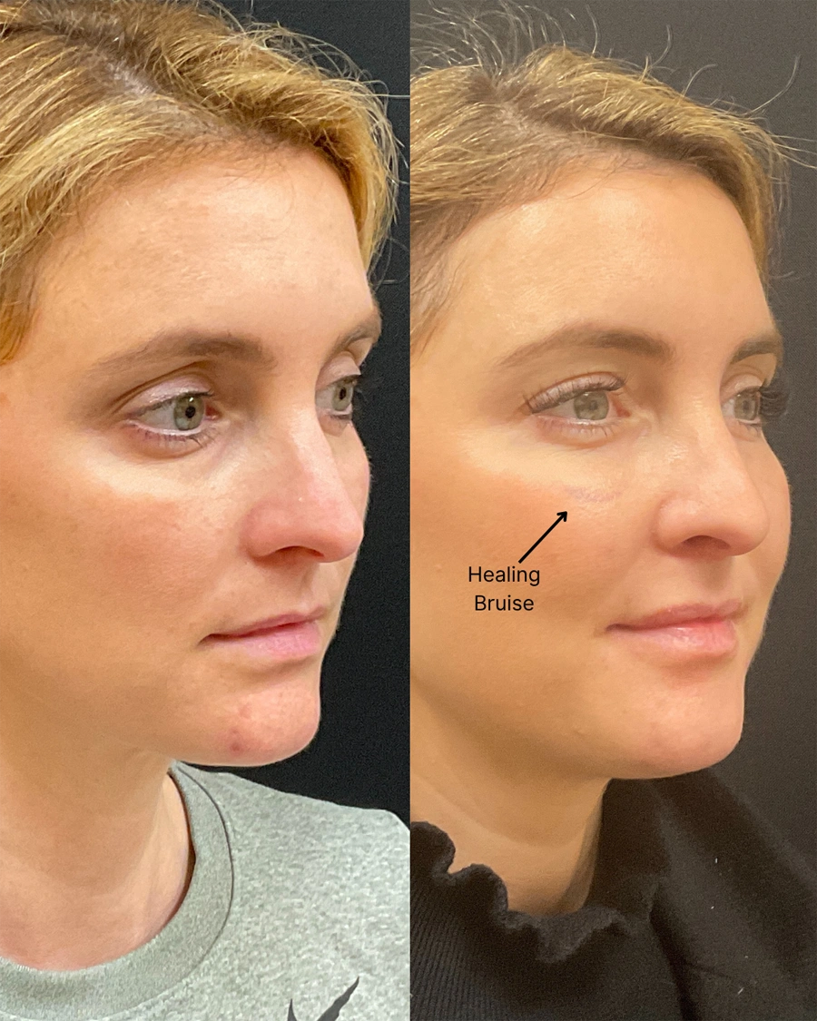 Before and after oculofacial plastic surgery results in Atlanta, GA, performed by Dr. Sahitya Reddy.