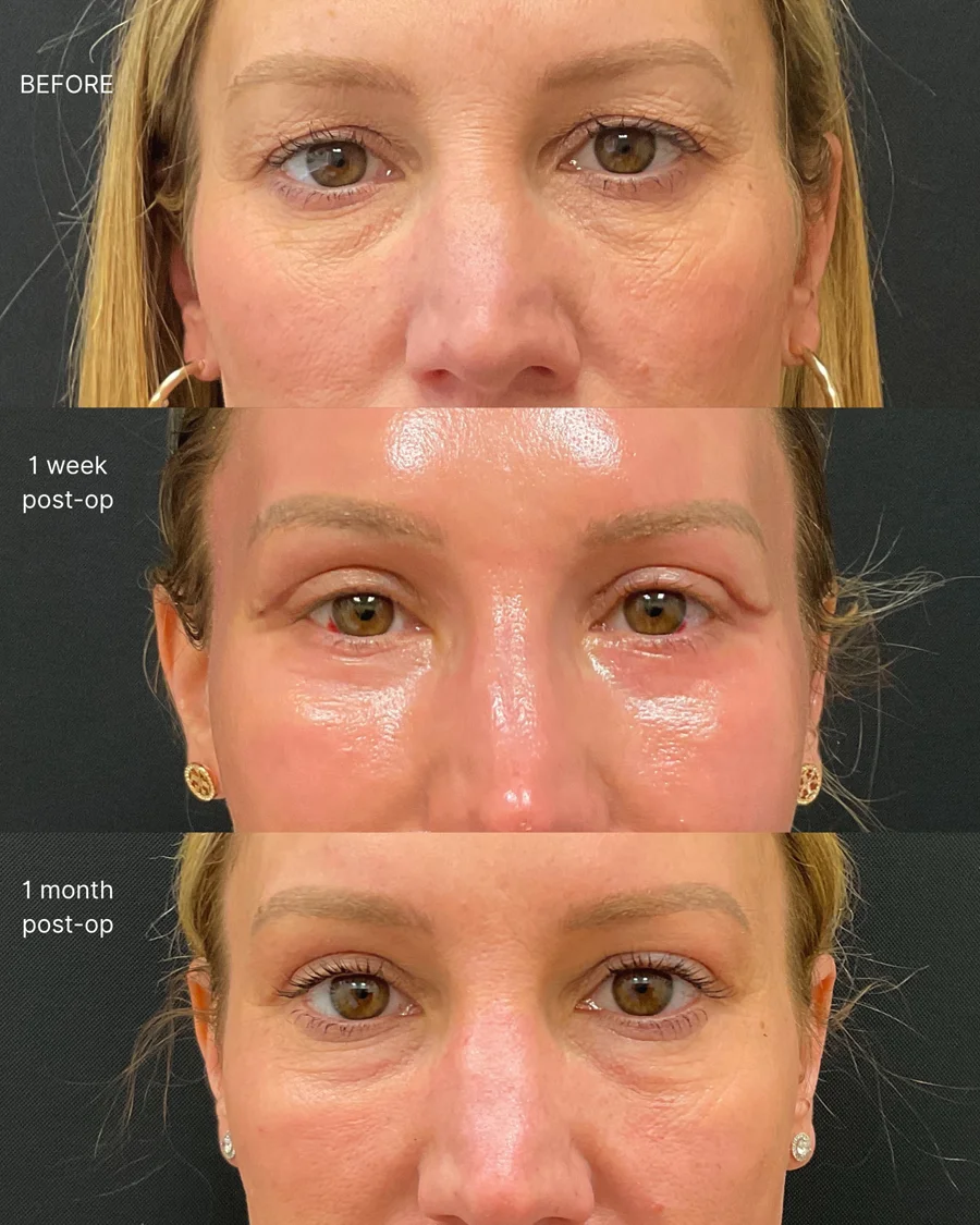 Before and after oculofacial plastic surgery results in Atlanta, GA, performed by Dr. Sahitya Reddy.