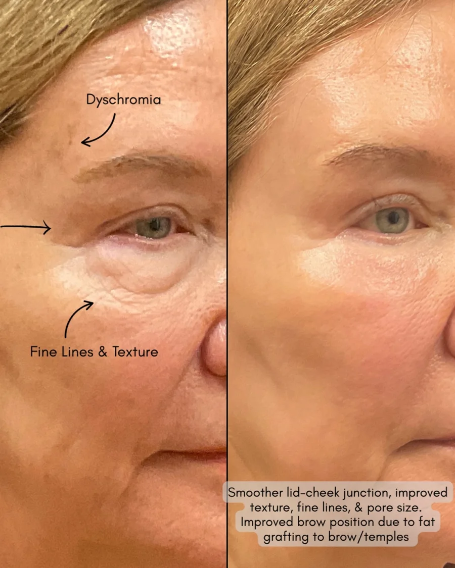 Before and after oculofacial plastic surgery results in Atlanta, GA, performed by Dr. Sahitya Reddy.