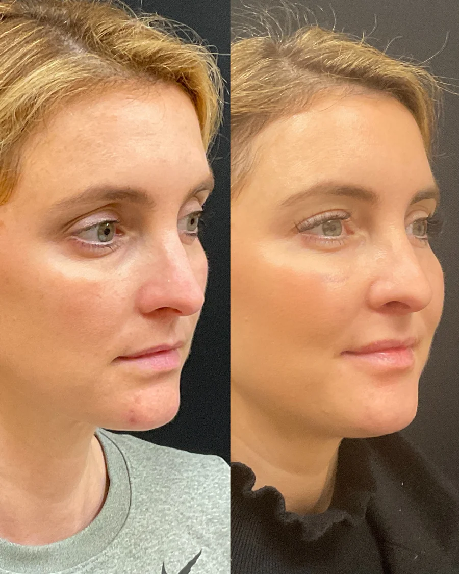 Before and after oculofacial plastic surgery results in Atlanta, GA, performed by Dr. Sahitya Reddy.
