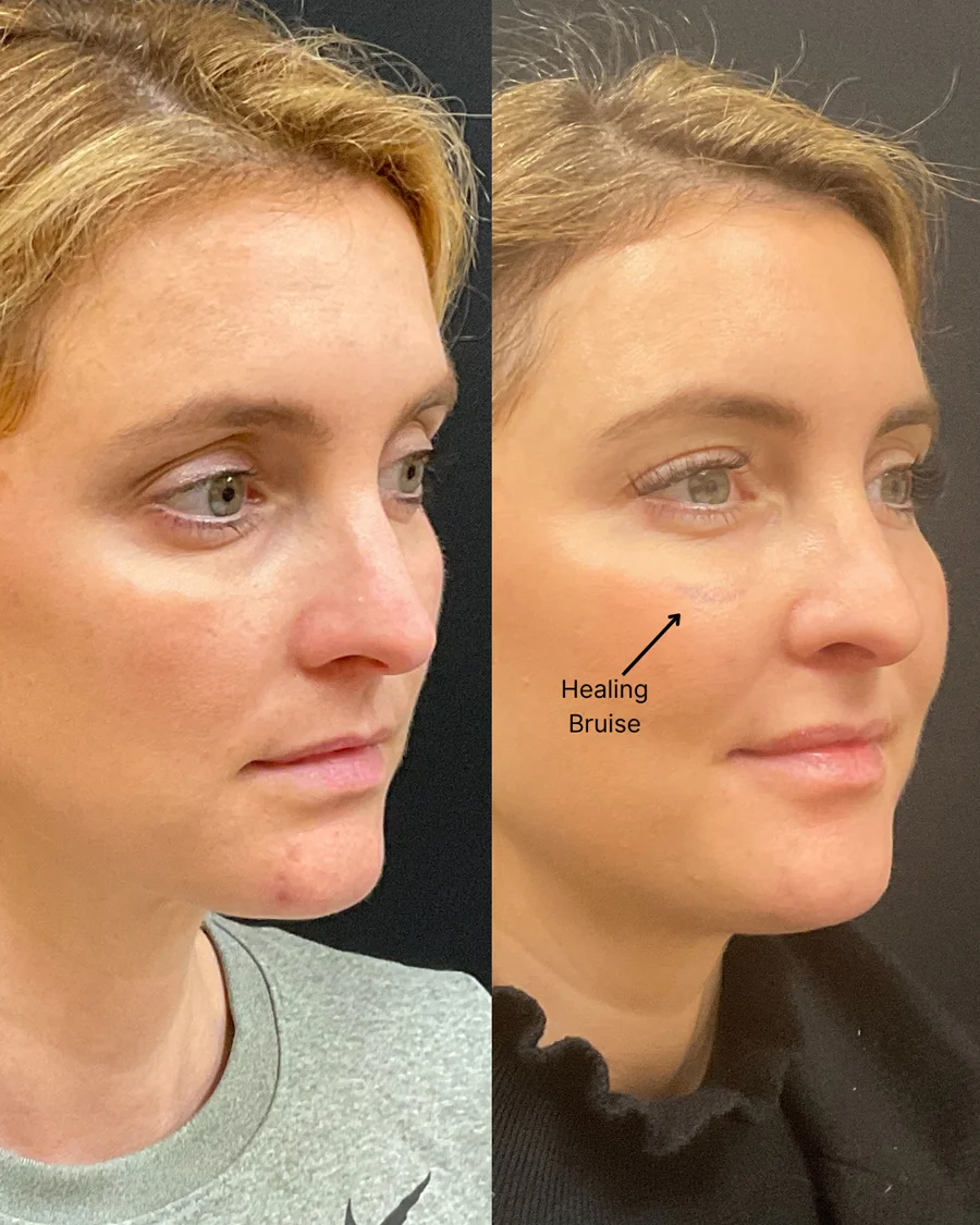 Before and after oculofacial plastic surgery results in Atlanta, GA, performed by Dr. Sahitya Reddy.
