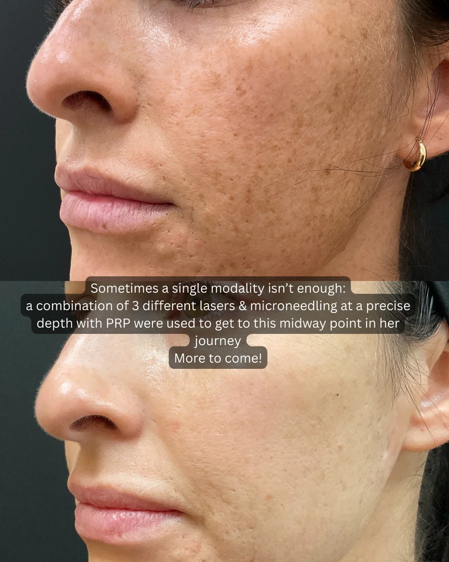Before and after oculofacial plastic surgery results in Atlanta, GA, performed by Dr. Sahitya Reddy.