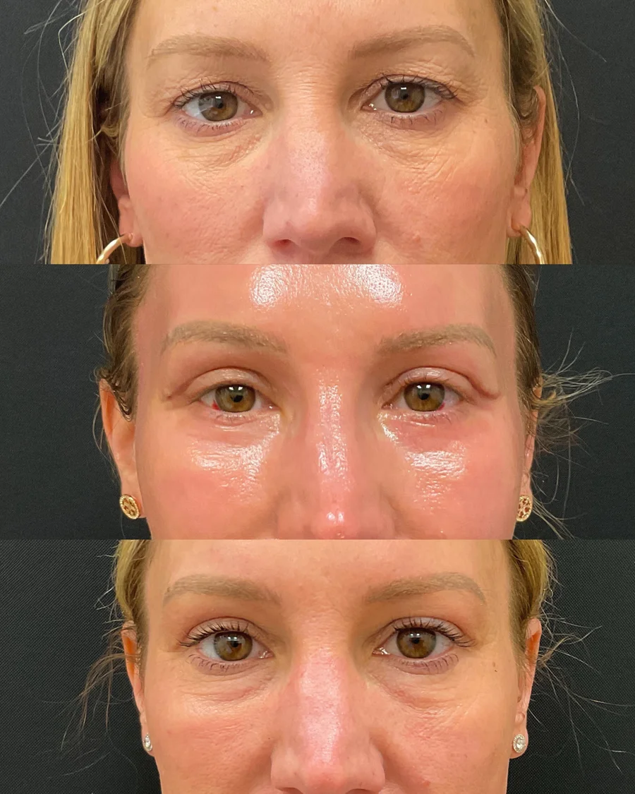 Before and after oculofacial plastic surgery results in Atlanta, GA, performed by Dr. Sahitya Reddy.