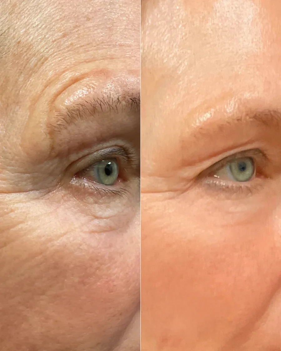 Before and after oculofacial plastic surgery results in Atlanta, GA, performed by Dr. Sahitya Reddy.